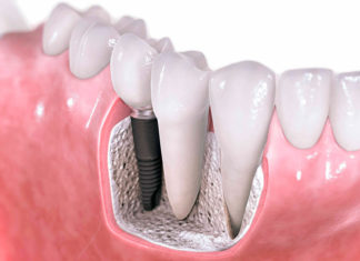 Виды зубных имплантов
