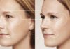 Контурная пластика лица филлерами: порядок проведения