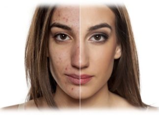 Азелаиновая кислота и пилинги в лечении акне