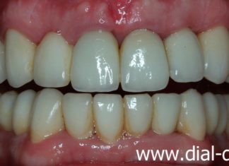 Реставрация зубов: какие могут возникнуть проблемы