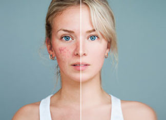 Как происходит удаление сосудов на лице