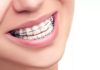 Металлические брекеты: преимущества и особенности