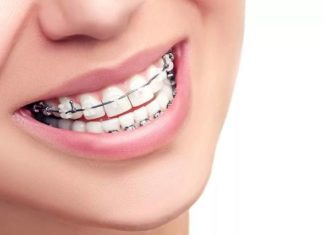 Металлические брекеты: преимущества и особенности