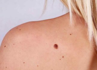 Особенности удаления папиллом