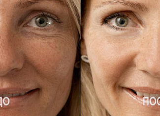 Мезотерапия: дань моде или реально работающий метод