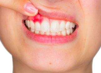 Виды заболеваний, поражающих десны