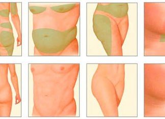 Как делают липосакцию отдельных частей тела?