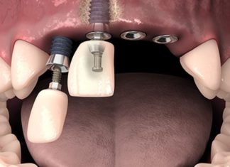 Установка имплантов: прогрессивный метод протезирования в современной стоматологии