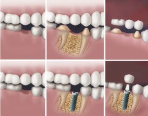 Имплантация или протезирование: что лучше?