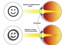 Астигматизм: причины, симптомы и лечение