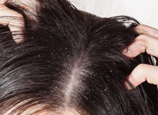 Распространённые причины появления перхоти