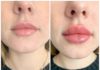 Показания к увеличению губ филлером
