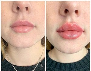 Показания к увеличению губ филлером