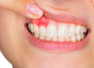 Почему важно вовремя начинать лечение десен?