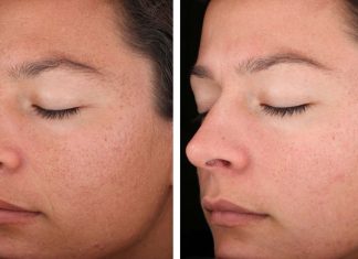 Какой эффект даёт лазерная шлифовка лица?