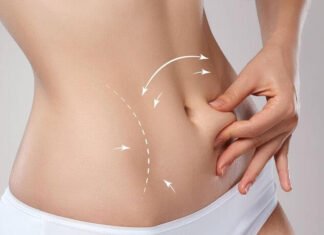 Сколько кг можно потерять при липосакции?