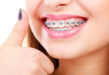 Установка брекетов: что важно знать